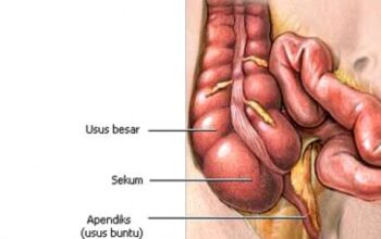 Apa itu Penyakit Radang Usus dan Siapa Saja yang Paling Berisiko Mengalami?